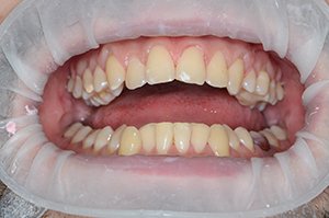 Полировка и шлифовка зубов — цена полирования зубов в СПб в стоматологии «Symmetrica»